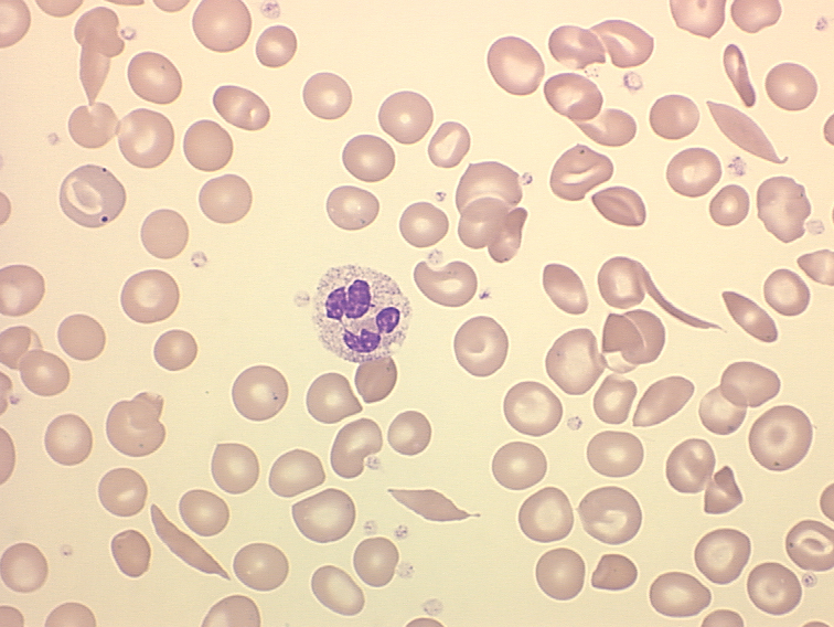 Cases: Hematopoiesis and Lymphoid