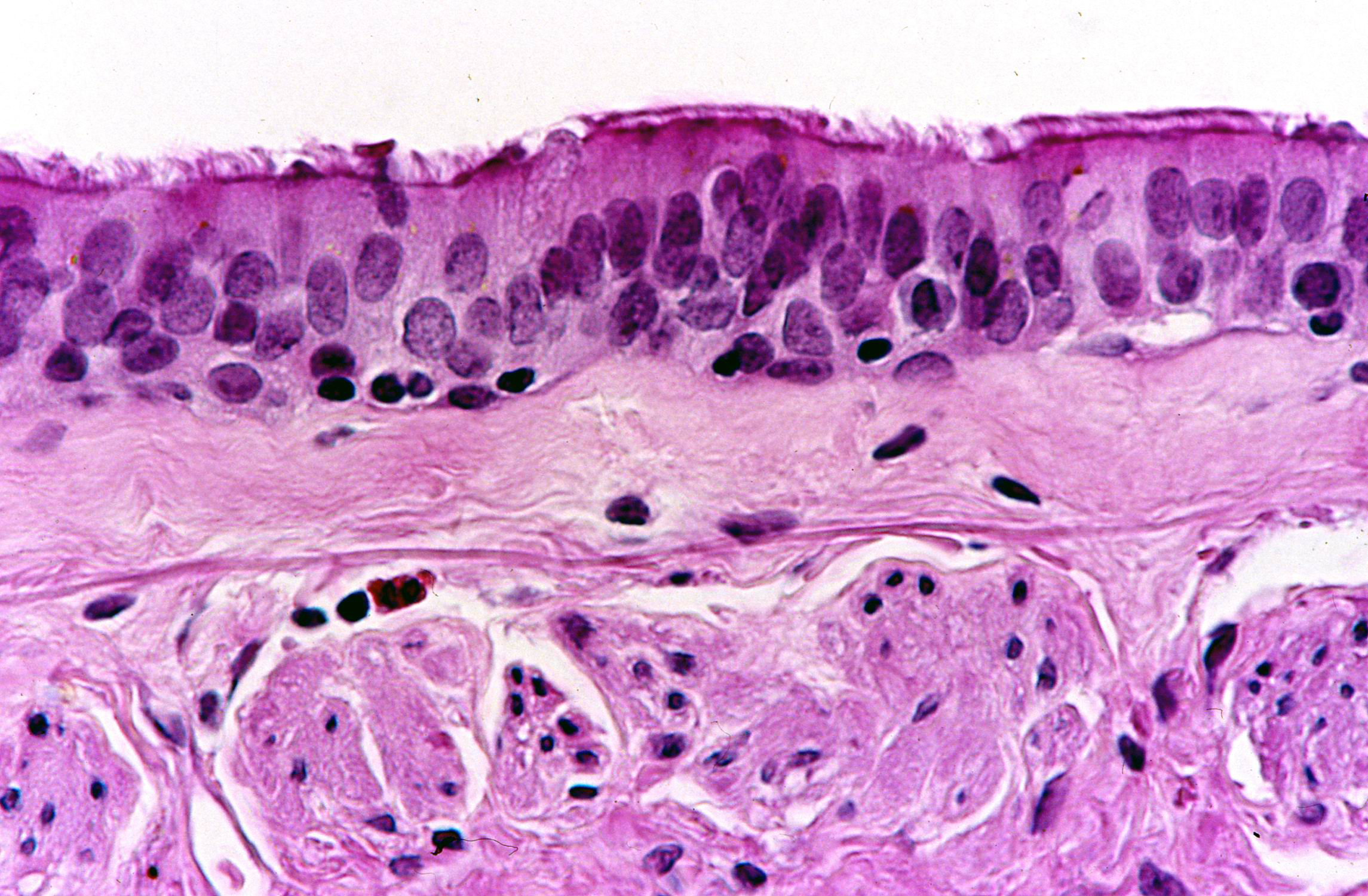 Pathology of Chronic Obstructive Lung Disease